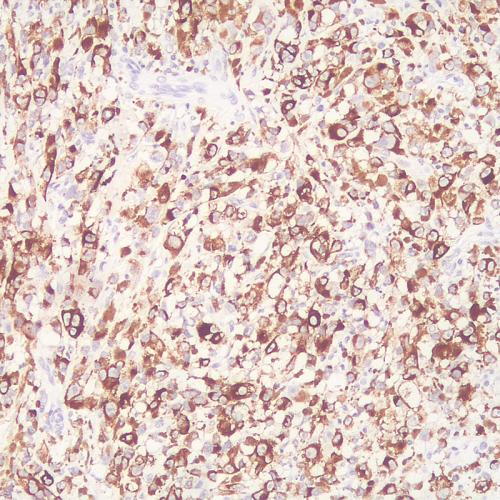 Melanoma